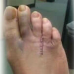 Morton's neuroma surgery