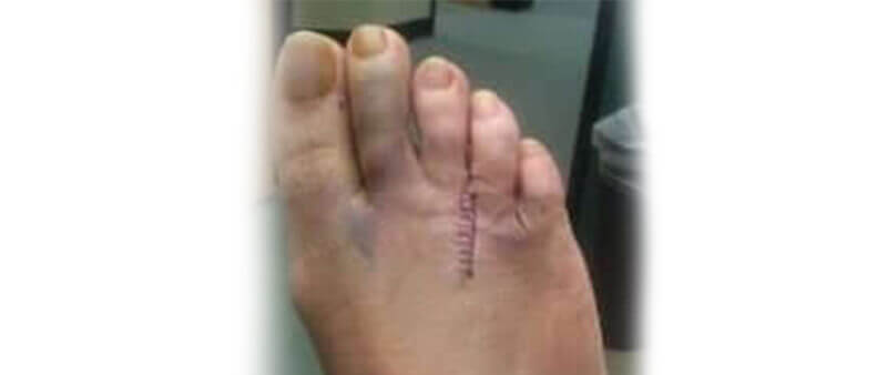 Morton's neuroma surgery