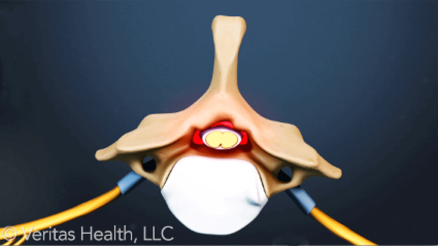 spinal stenosis