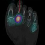 Conditions that mimic Morton's neuroma: Stress fracture