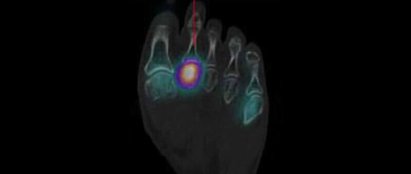 Conditions that mimic Morton's neuroma: Stress fracture