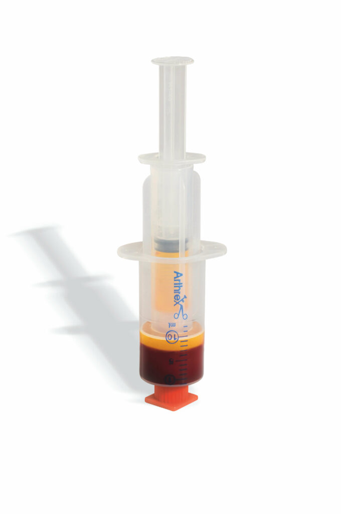 PRP for mortons neuroma