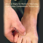 neuroma causes