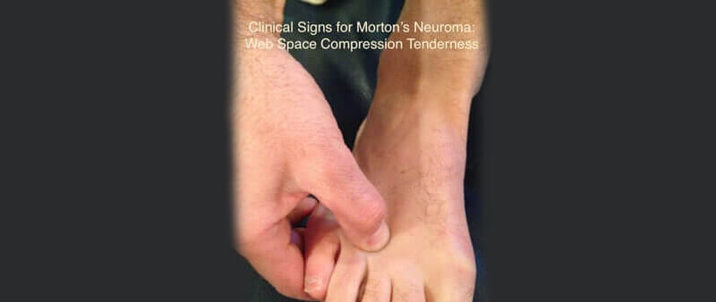 neuroma causes