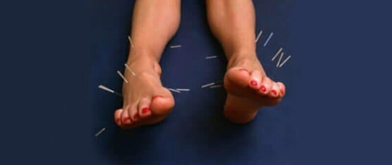 acupunture for foot pain