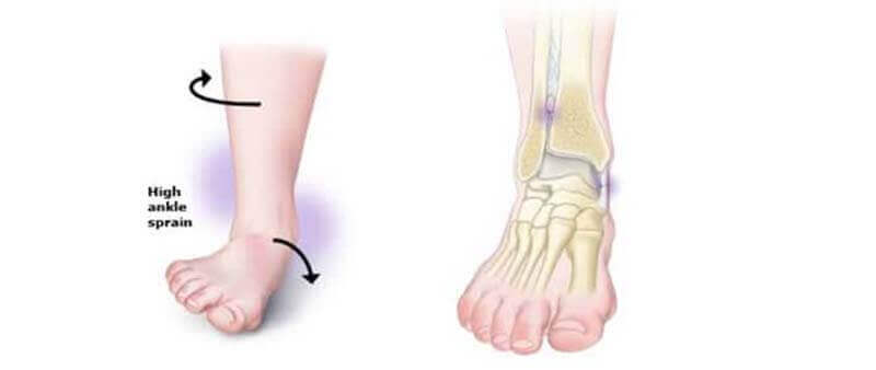 foot pain