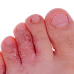 athletes foot in summer