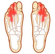 mortons neuroma both feet