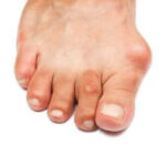bunions