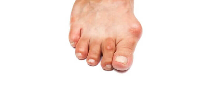 bunions