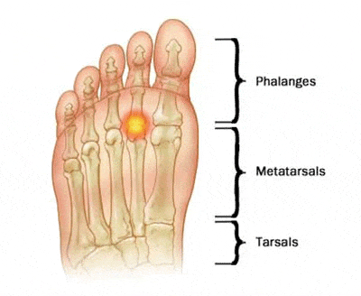 Morton's neuroma capulitis