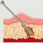 fat pad atrophy fat-graft-cells