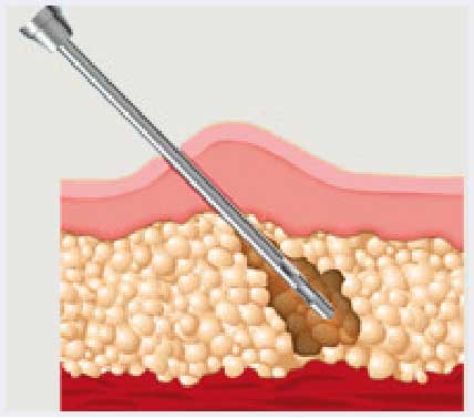 fat pad atrophy fat-graft-cells