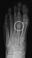 Morton's neuroma stress fractures