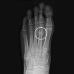 stress fractures of the foot