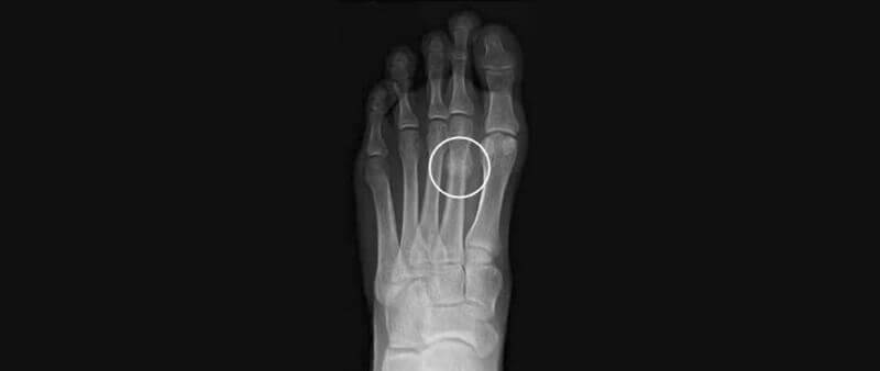 stress fractures of the foot