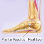 heel spur