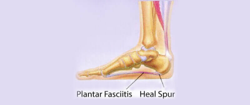 heel spur