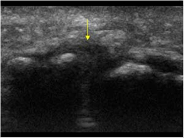 Morton's neruoma ultrasound