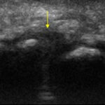 Morton's neuroma ultrasound