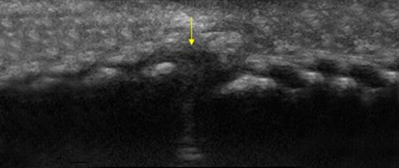 Morton's neuroma ultrasound