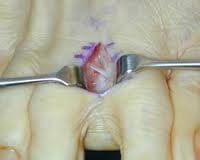 Morton's neuroma surgery