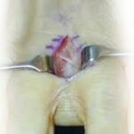 Morton's neuroma surgery