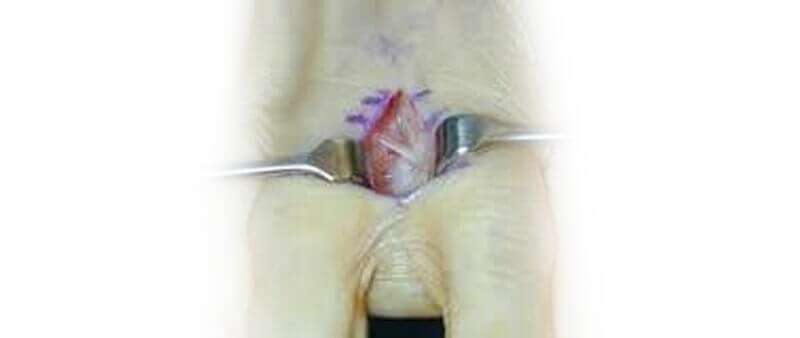 Morton's neuroma surgery