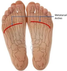 metatarsal arches