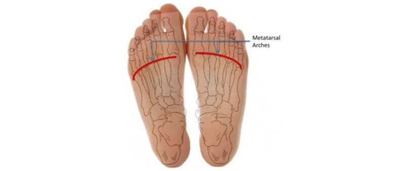 Inserts for sales morton's neuroma
