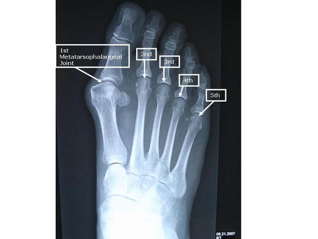 MTP joint pain