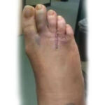 Morton's neuroma names