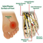 Morton's neuroma treatment