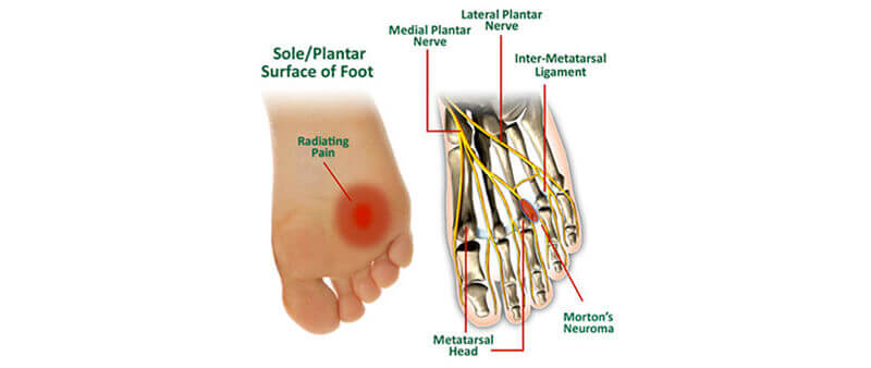 Morton's neuroma treatment