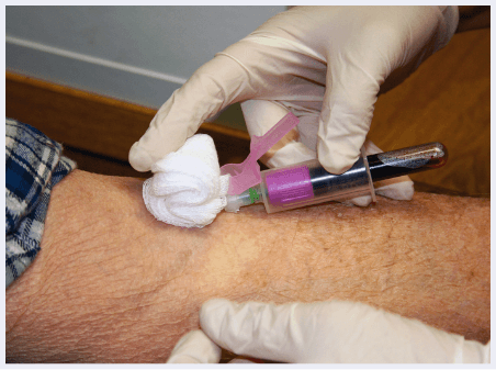 platelet-rich-plasma-theraphy-img