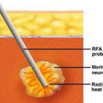 foot neuroma rf ablation
