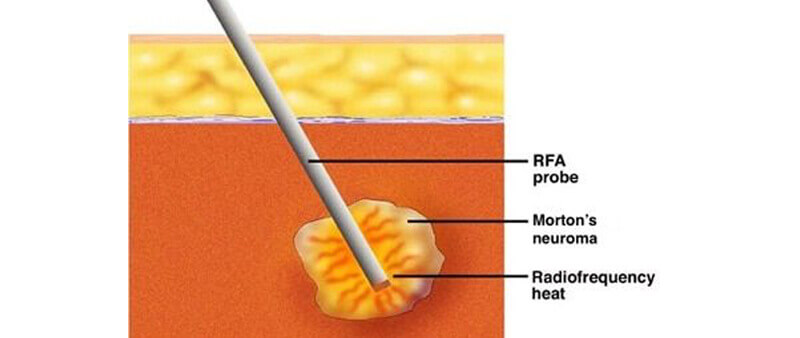 foot neuroma rf ablation