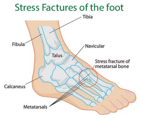 How common are stress fractures of the foot?