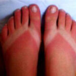 sunburnt feet
