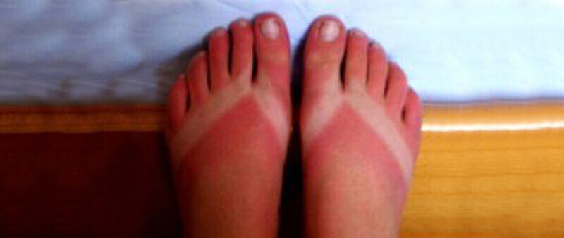 sunburnt feet