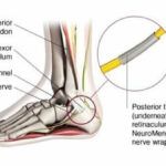 tarsal tunnel syndrome