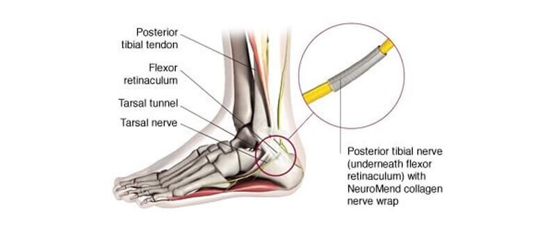 tarsal tunnel syndrome