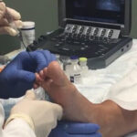 ultrasound guided treatment for mortons neuroma
