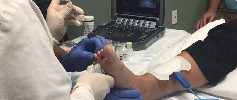 ultrasound guided treatment for mortons neuroma