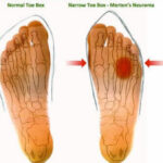 foot neuroma