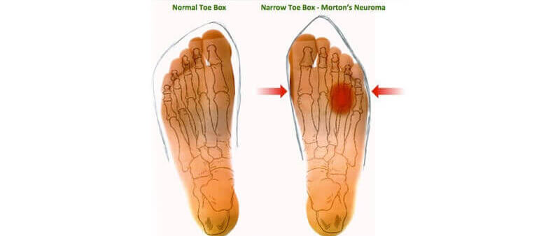 foot neuroma