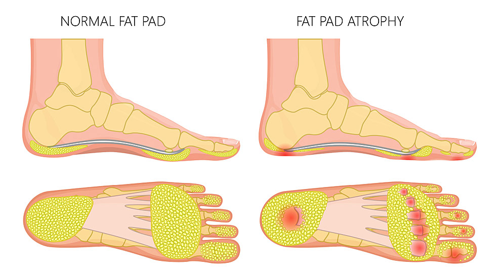 Heel Fat Pad Injury | Heel Pain Advice