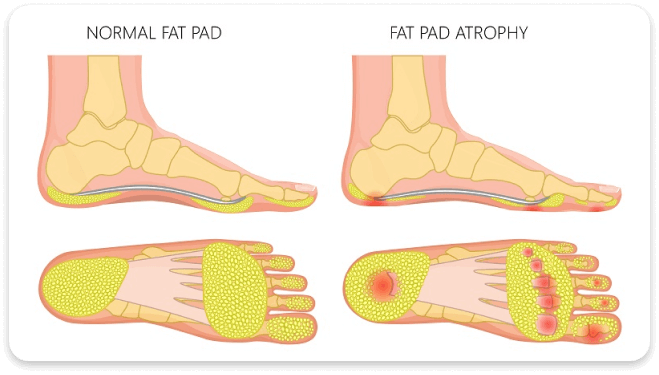 normal-fat-pad-and-fat-pad-atrophy-img