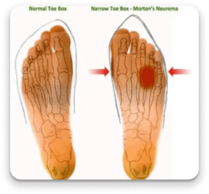 About Morton’s Neuroma - The Center for Mortons Neuroma